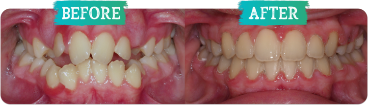 Orthodontic Before and After Photo Cross bite