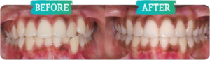 Orthodontic before and afters