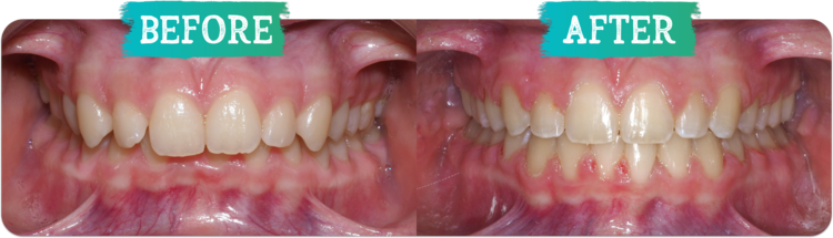 Orthodontic Before and After Photo Deep Bite
