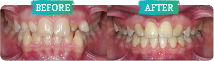 Orthodontic Before & Afters