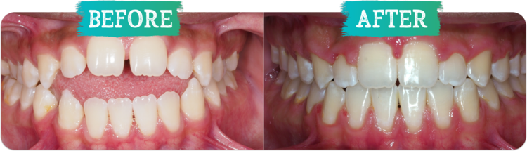 Orthodontic before and afters