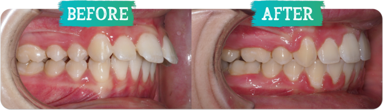 Overbite Before and After