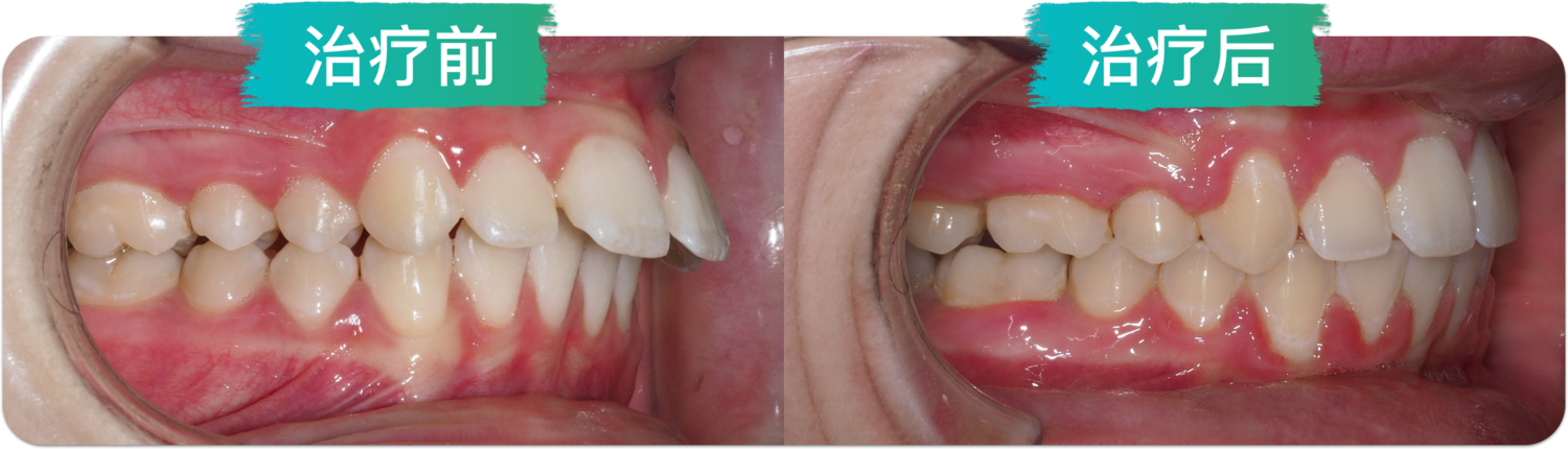 龅牙(牙齿前突