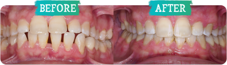 Orthodontic before and afters