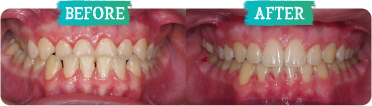 Underbite Before and After