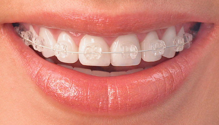 Clear Braces – Elk Grove Village & Hanover Park - Invisible Orthodontic  Braces In IL