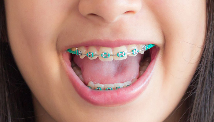 embrace orthodontics