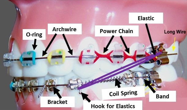 Braces and Power Chains