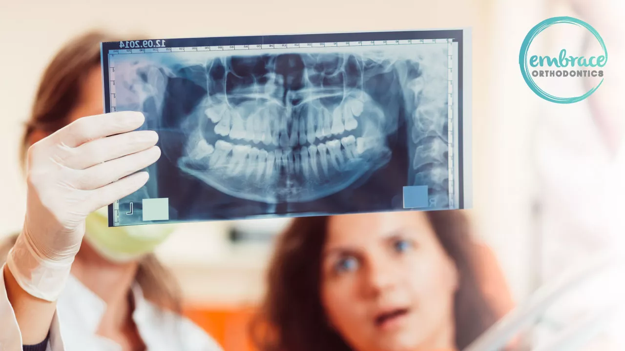 Orthodontic Treatment & Wisdom Teeth Extractions