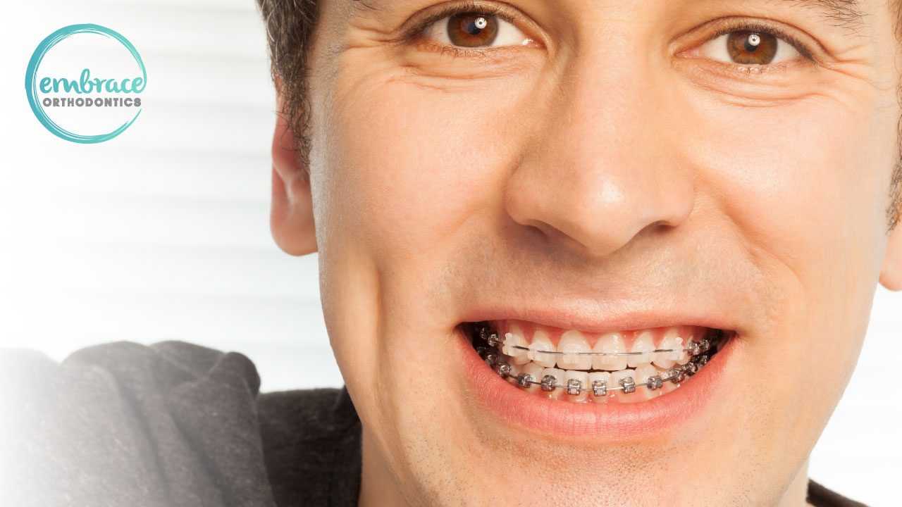 The history of braces is one we can all be thankful for.