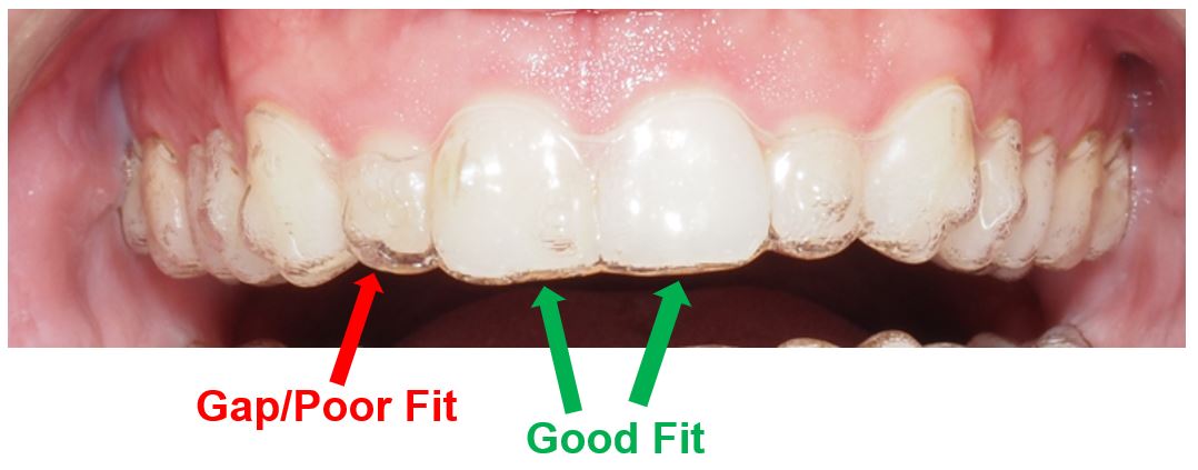 Aligners: How Should They Fit? Tips to Getting the Right Fit