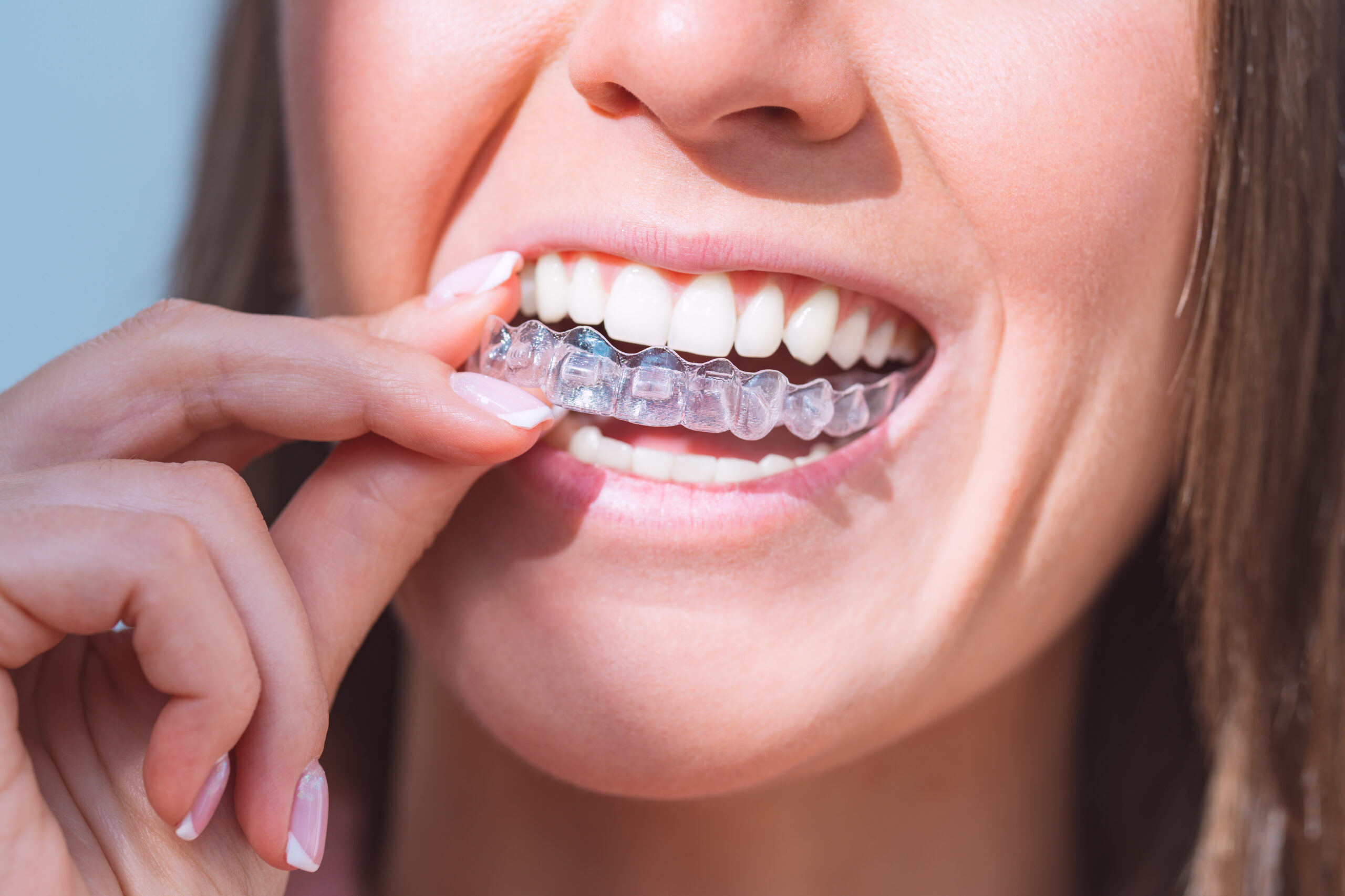 clear aligners near ann arbor