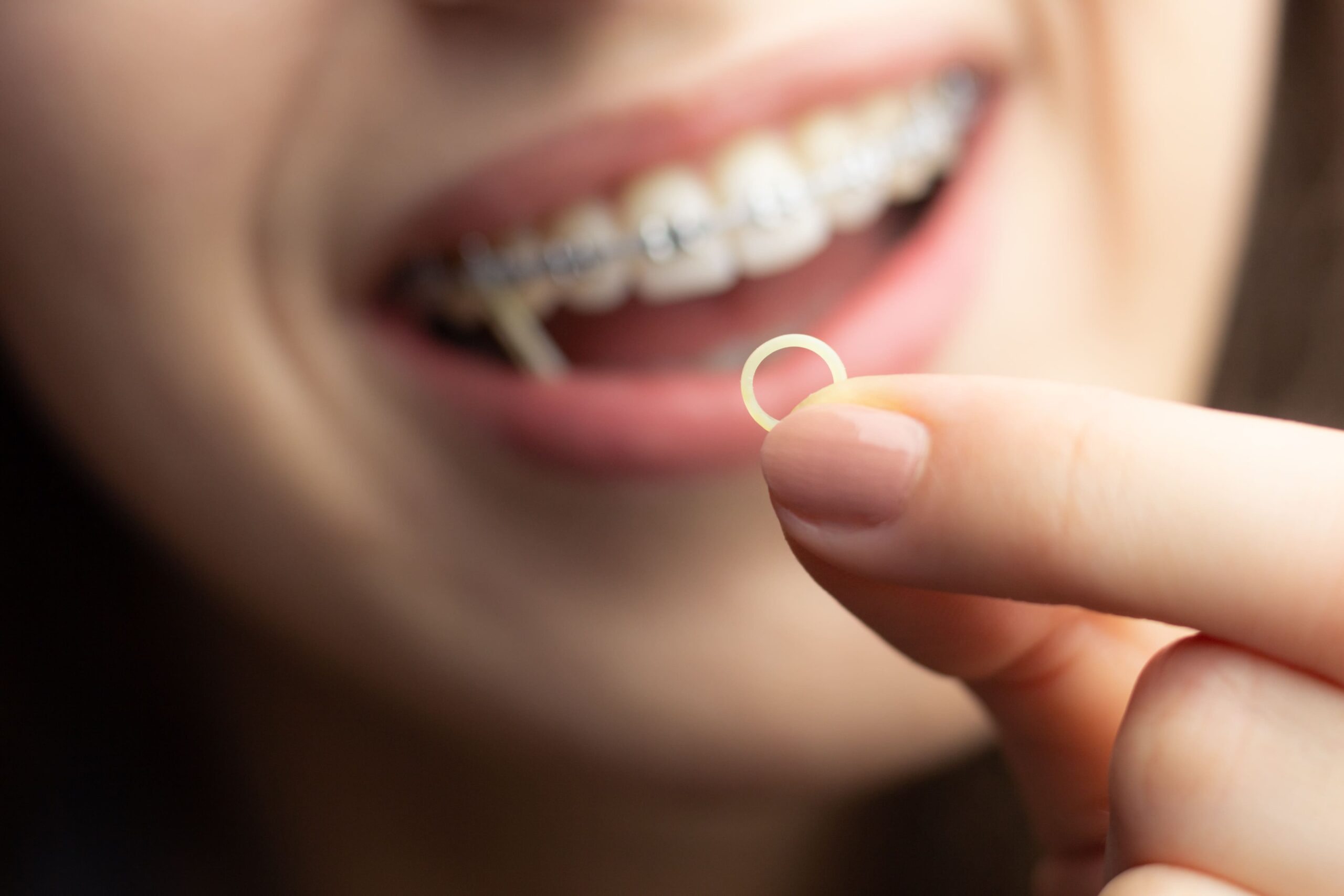 What Are Rubber Bands for Braces and Why Do I Need Them?